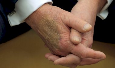 كدمة داكنة على يد ترامب تثير جدلًا واسعًا.. والبيت الأبيض يوضح الأسباب