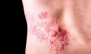 الحزام الناري: أخطر مضاعفاته وأهم طرق الوقاية