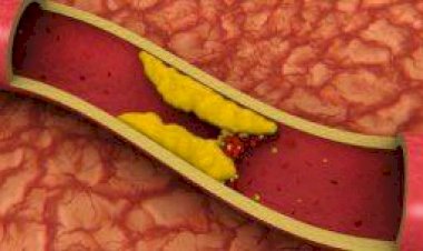 تعرف على أسباب ارتفاع كوليسترول الدم