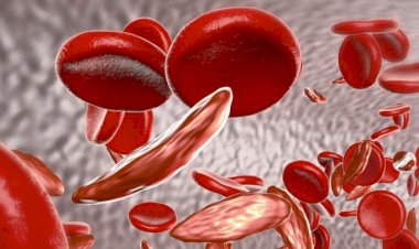 خطورة نقص الحديد بالجسم.. الأعراض والعلاج