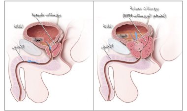 تقرير شامل عن تضخم البروستاتا: الأسباب و الأعراض والعلاج