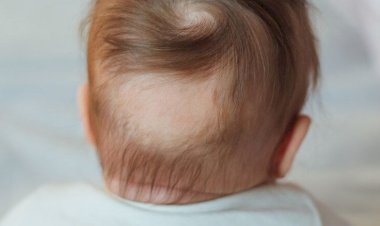 تساقط الشعر عند الأطفال.. الأسباب والعلاج وطرق الوقاية