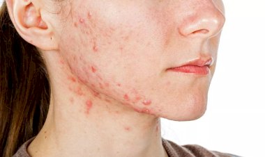 حلول طبيعية للتخفيف من حبّ الشباب في المنزل