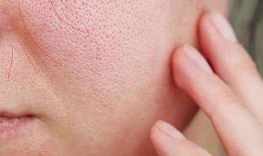 وصفات طبيعية لعلاج مشكلة المسام الواسعة بخطوات سهلة وفعالة للحصول على بشرة أنعم