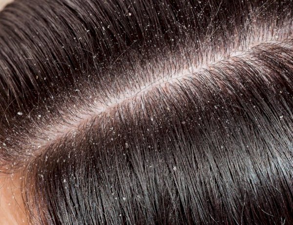 القشرة الدهنية: مشكلة مزعجة وحلول فعّالة لاستعادة صحة فروة الرأس