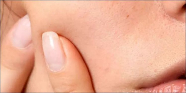 تعرف على علاج الحبوب تحت الجلد