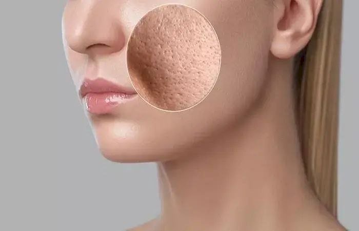 8 وصفات طبيعية لعلاج المسام الواسعة وتحسين ملمس البشرة