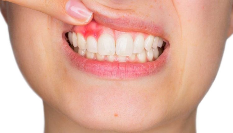 ماذا تنذر تغيرات الفم.. أعراض مبكرة تكشف إصابتك بأمراض مزمنة